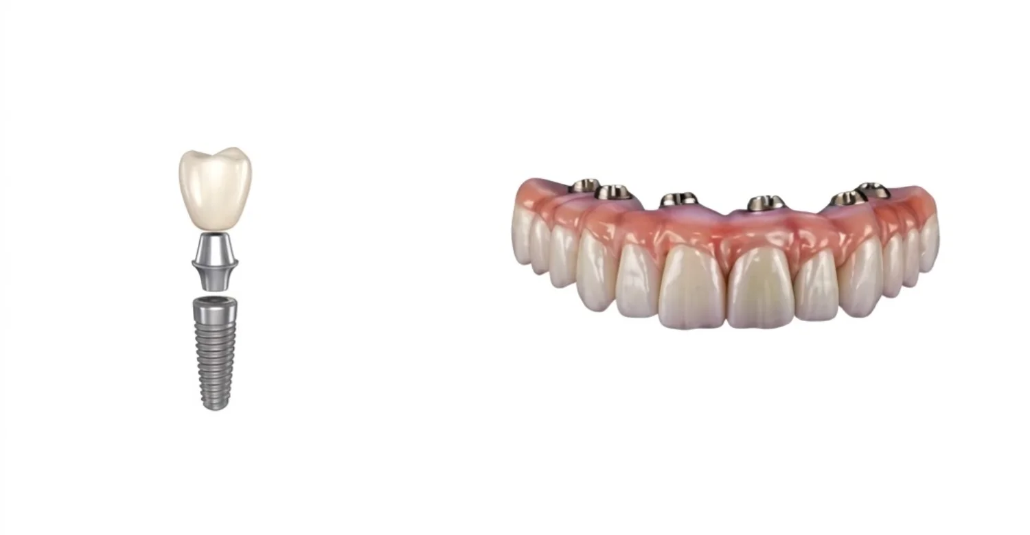 Implant dentaire unique comparé à des implants dentaires multiples